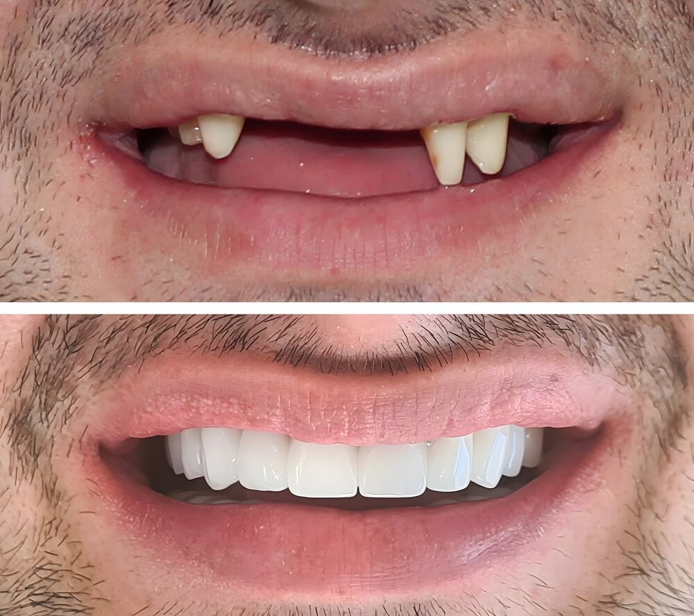 Before and after dental implants - Natural-looking transformation